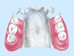 コーヌスクローネデンチャー