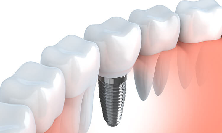 失った歯の機能を回復させましょう