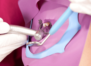 ラバーダムの使用で感染を防止