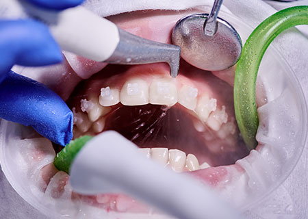 「エアフロー」で着色汚れを落として歯をきれいに