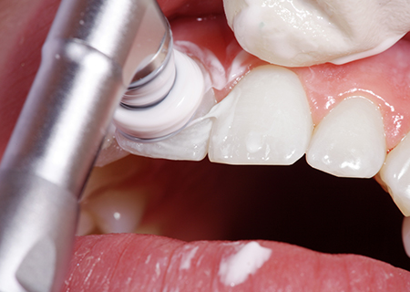 歯科衛生士によるクリーニング