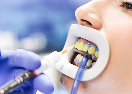 ホワイトニング治療