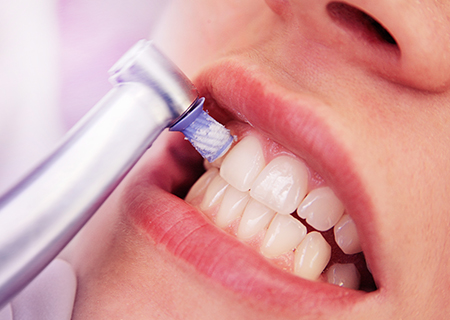 歯科衛生士によるクリーニング