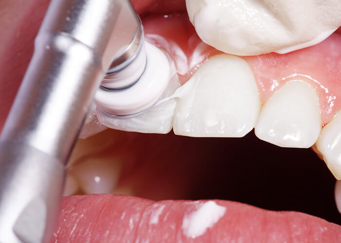 PMTC/フッ素塗布(必要に応じて)