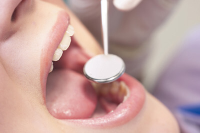 SPT（歯周病の再発予防）