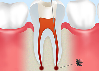 悪化した虫歯を抜歯から救うために～根管治療～